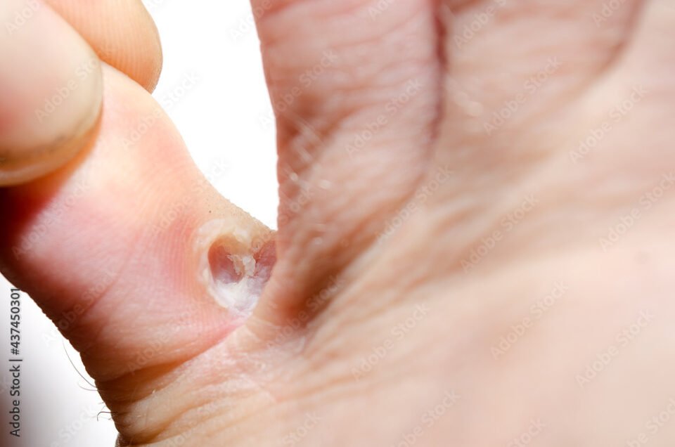 Stephen Kerr, Horsham Foot Care Specialist can clear up your athlete's foot.