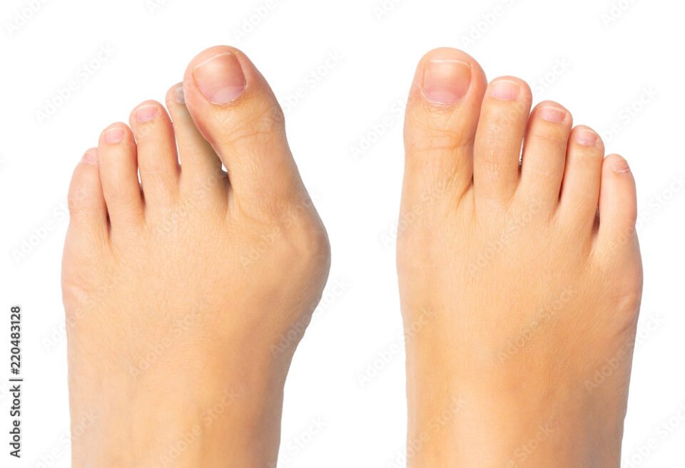 Horsham footcare specialist Stephen Kerr can help deal with your painful bunions.