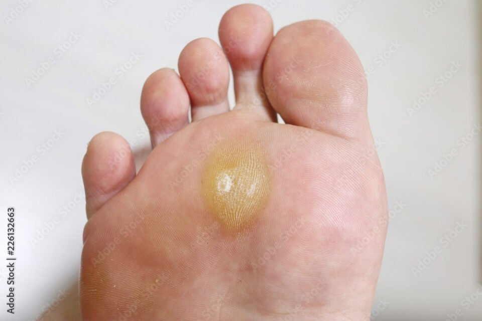 Co0ntact Stephen Kerr, Horsham foot care specialist, to get rapid treatment of calluses and corns.