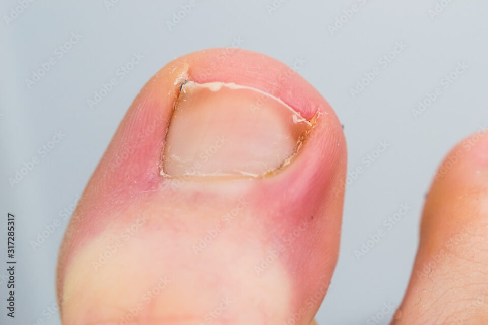 Ingrown Toenails can be dealt with quickly by Horsham Footcare Specialist Stephen Kerr.