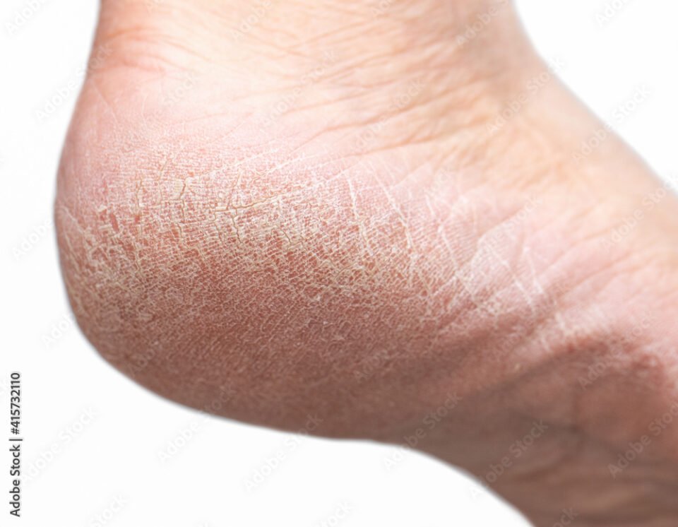 Contact Stephen Kerr, Horsham Footcare Specialist, to quickly remedy your cracked heels.