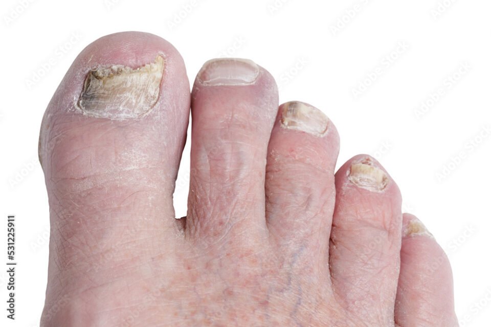 Horsham foot care specialist, Stephen Kerr, will provide a course of treatment to clear up fungal nail infections.